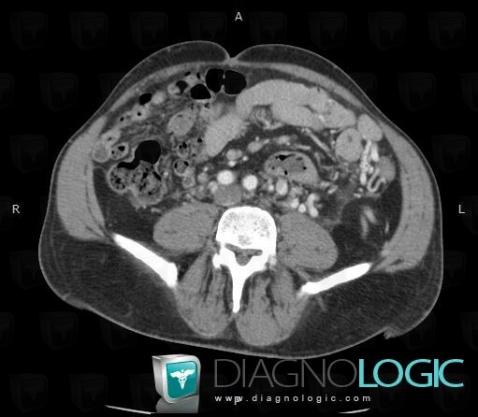 Thrombose veineuse profonde complication