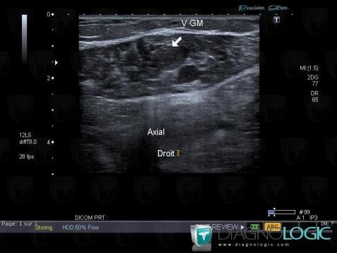 Thrombose veineuse superficielle, Veines - Jambe, Echographie
