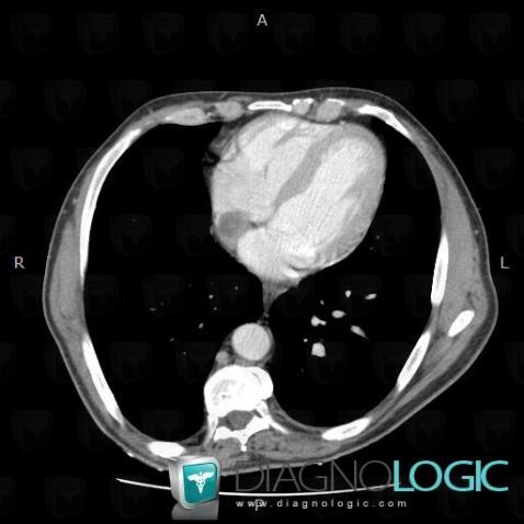 Thrombus intra cardiaque, Cavités cardiaques / Péricarde, Scanner