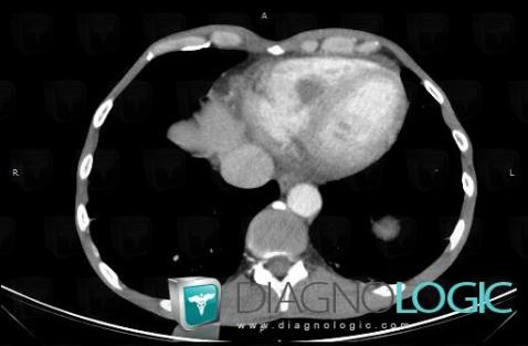 Thrombus intra cardiaque, Cavités cardiaques / Péricarde, Scanner