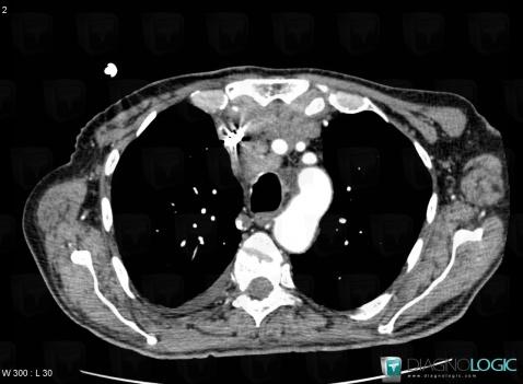 Thymic carcinoma, Mediastinum, CT