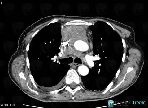 Thymic carcinoma, Mediastinum, CT