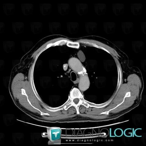 Thymic cyst, Mediastinum, CT