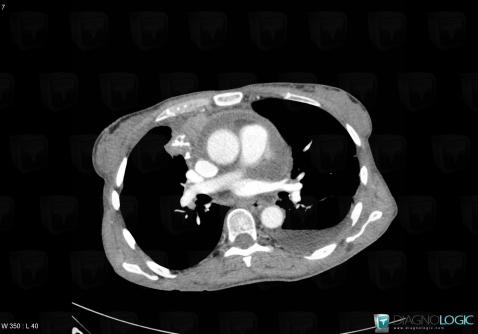 Thymoma, Cardiac cavities / Pericardium, CT