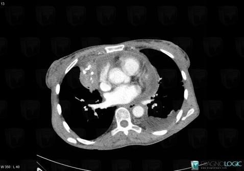 Thymoma, Mediastinum, Cardiac cavities / Pericardium, CT