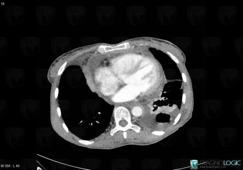 Thymoma, Mediastinum, CT