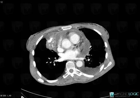 Thymoma, Mediastinum, CT