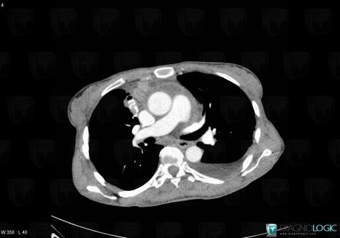 Thymoma, Pleura, CT