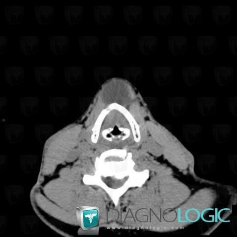 Thyroglossal duct cyst, Deep neck spaces, CT