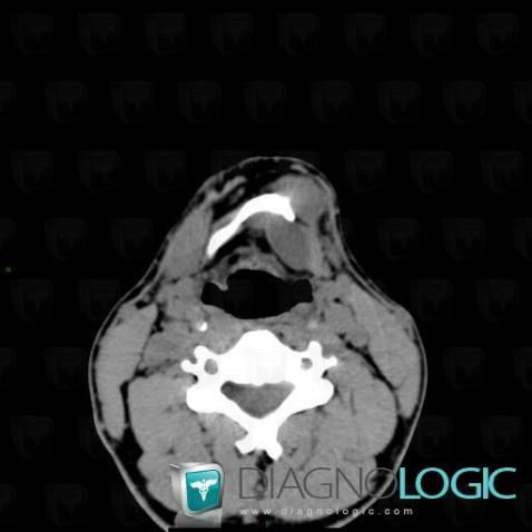 Thyroglossal duct cyst, Deep neck spaces, CT