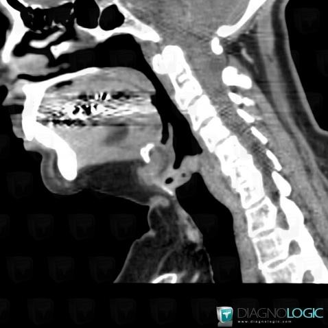 Thyroglossal duct cyst, Deep neck spaces, CT