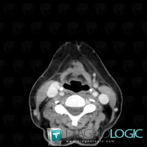 Thyroglossal duct cyst, Larynx, CT