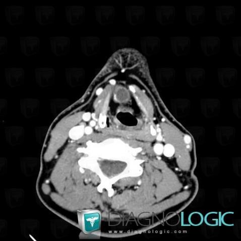 Thyroglossal duct cyst, Larynx, Deep neck spaces, CT