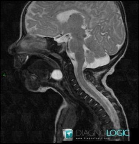 Thyroglossal duct cyst, Oropharynx / Floor-mouth, MRI