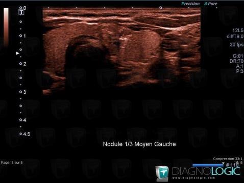 Thyroid carcinoma, Thyroid / Parathyroid, US