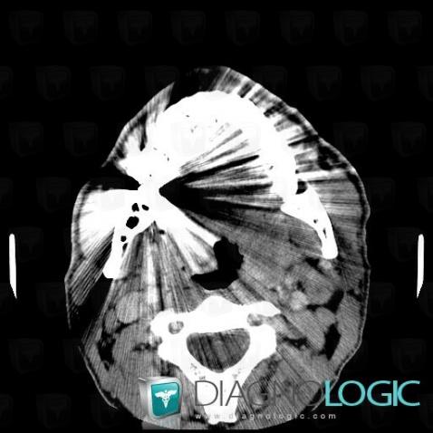 Tonsil cancer, Oropharynx / Floor-mouth, CT