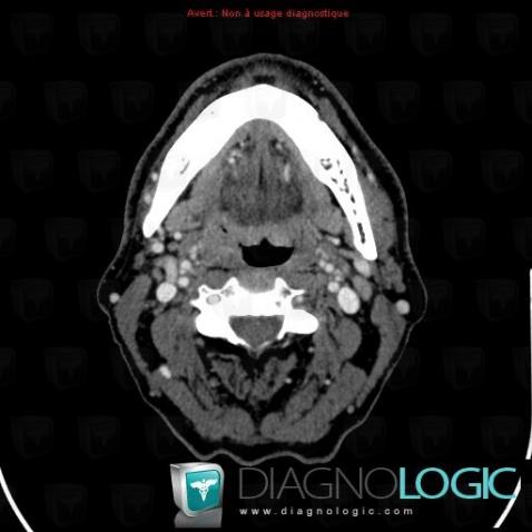 Tonsil cancer, Oropharynx / Floor-mouth, CT