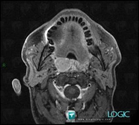 Tonsil cancer, Oropharynx / Floor-mouth, MRI