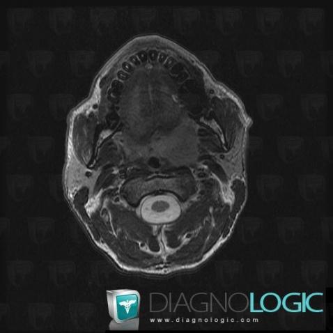 Tonsil cancer, Oropharynx / Floor-mouth, MRI