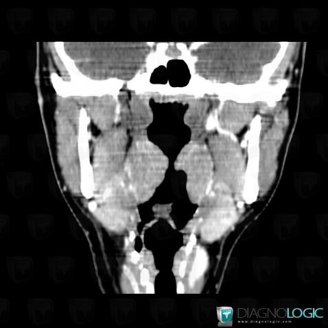 Tonsillar hypertrophy, Oropharynx / Floor-mouth, CT