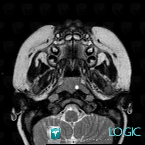 Tornwaldt cyst, Nasal cavity / Nasopharynx, MRI