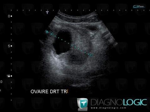 Torsion d'ovaire, Annexe / Ovaire - trompe, Pelvis / Périnée, Echographie