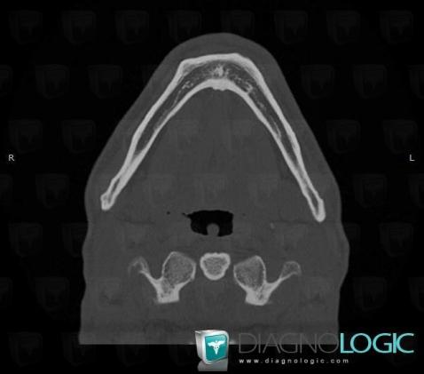 Torus mandibularis, Mandible, CT