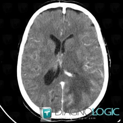 Toxoplasmosis, Basal ganglia and capsule, CT