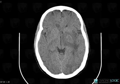 Toxoplasmosis, Basal ganglia and capsule, CT