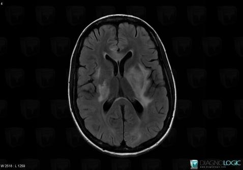 Toxoplasmosis, Basal ganglia and capsule, MRI