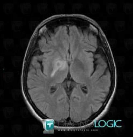 Toxoplasmosis, Basal ganglia and capsule, MRI