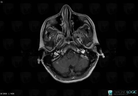 Toxoplasmosis, Cerebellar hemisphere, MRI