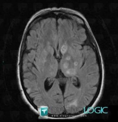 Toxoplasmosis, Cerebral hemispheres, Basal ganglia and capsule, MRI