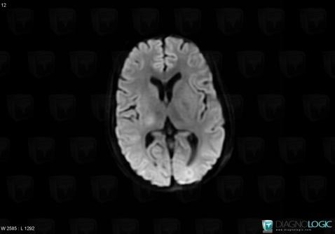 Toxoplasmosis, Cerebral hemispheres, Basal ganglia and capsule, MRI