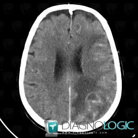 Toxoplasmosis, Cerebral hemispheres, CT