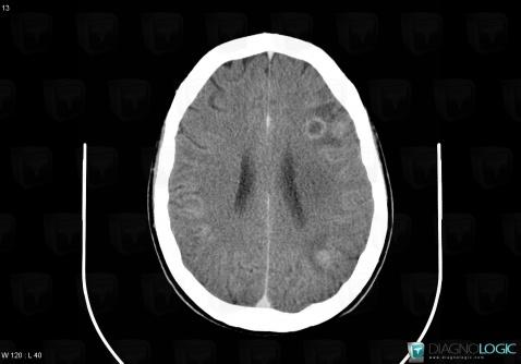 Toxoplasmosis, Cerebral hemispheres, CT