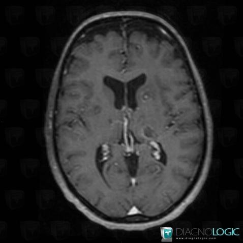 Toxoplasmosis, Cerebral hemispheres, MRI