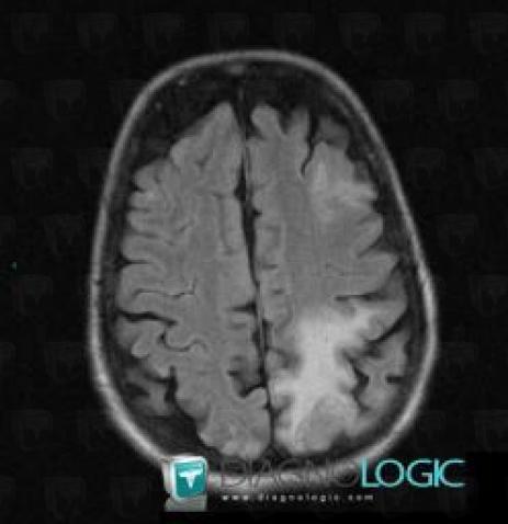 Toxoplasmosis, Cerebral hemispheres, MRI