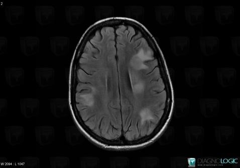 Toxoplasmosis, Cerebral hemispheres, MRI