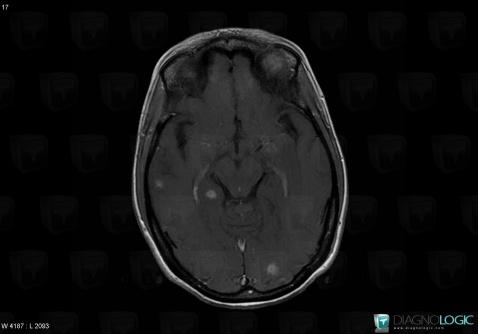 Toxoplasmosis, Cerebral hemispheres, MRI