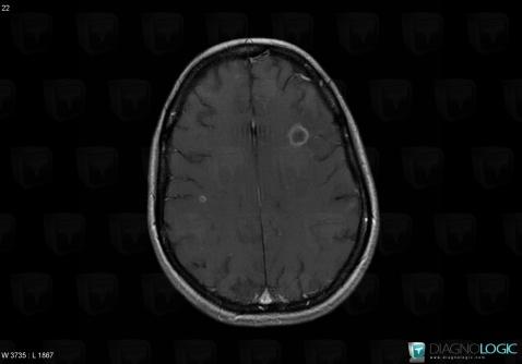 Toxoplasmosis, Cerebral hemispheres, MRI