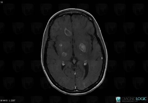 Toxoplasmosis, Cerebral hemispheres, MRI