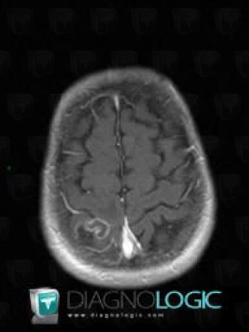 Toxoplasmosis, Cerebral hemispheres, MRI