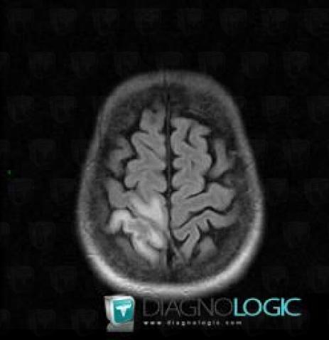 Toxoplasmosis, Cortico subcortical region, Cerebral hemispheres, MRI