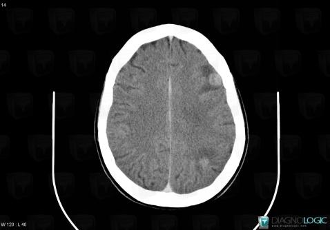 Toxoplasmosis, Cortico subcortical region, CT
