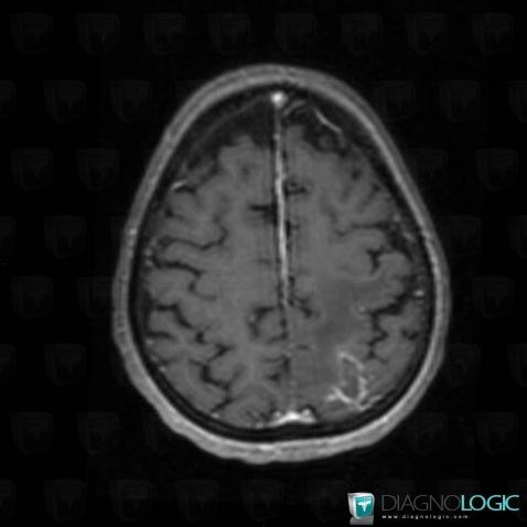 Toxoplasmosis, Cortico subcortical region, MRI