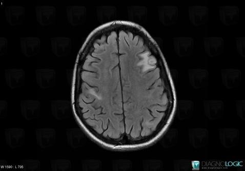 Toxoplasmosis, Cortico subcortical region, MRI