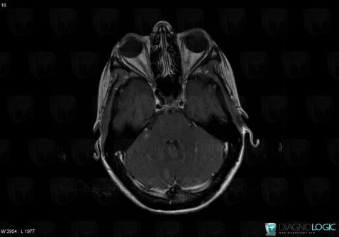 Toxoplasmosis, Posterior fossa, MRI