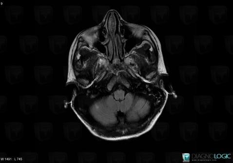 Toxoplasmosis, Posterior fossa, MRI