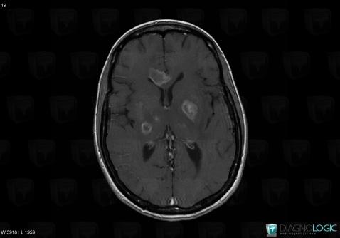 Toxoplasmosis, Ventricles / Periventricular region, MRI